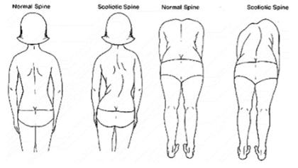 a person's back with and without scoliosis